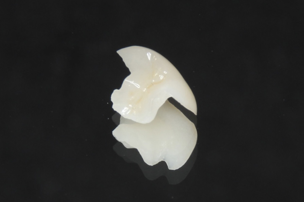 E-MAX（インレー・アンレー）